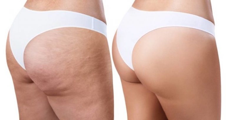 Celulitis