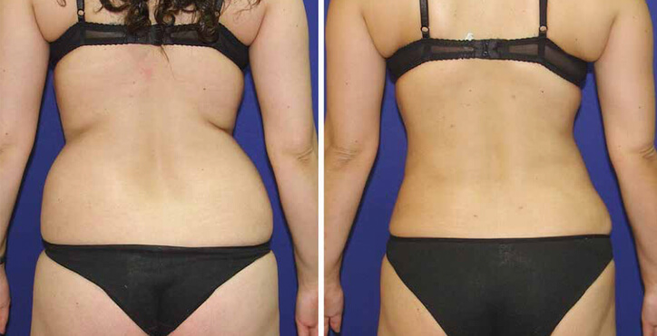Hidrolipoclasia