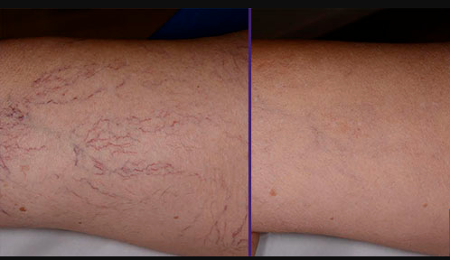 Varices